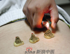 灸法的種類  你知道多少？